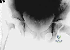 صورة طبية: تصريف التهاب مفصل الفخذ القيحي عند الأطفال: دليل شامل للآباء