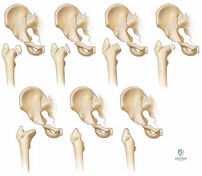 صورة طبية: تصريف التهاب مفصل الفخذ القيحي عند الأطفال: دليل شامل للآباء