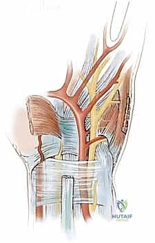 Ulnar Nerve Decompression at Guyon's Canal: An Intraoperative Masterclass
