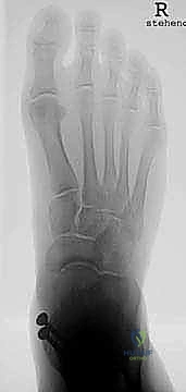 تفاصيل المكون المعدني لعظم الساق