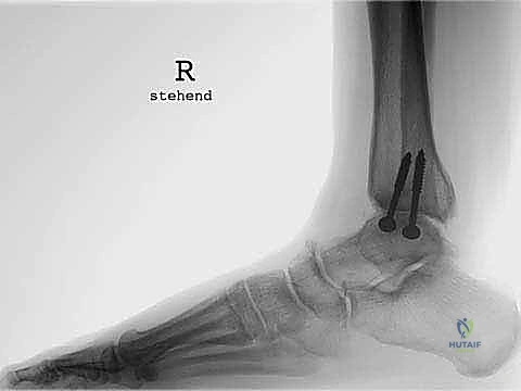 تصميم المكون المتحرك والبلاستيكي