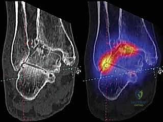 تحضير عظم الساق جراحياً