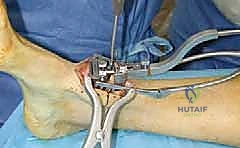 صورة طبية: مفصل الكاحل الصناعي الكلي HINTEGRA: استعادة الحركة والتخلص من الألم مع الأستاذ الدكتور محمد هطيف في صنعاء