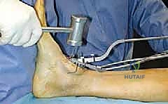 مفصل الكاحل الصناعي الكلي HINTEGRA: استعادة الحركة والتخلص من الألم مع الأستاذ الدكتور محمد هطيف في صنعاء