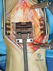 صورة طبية: مفصل الكاحل الصناعي الكلي HINTEGRA: استعادة الحركة والتخلص من الألم مع الأستاذ الدكتور محمد هطيف في صنعاء