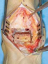 الوصول إلى مفصل الكاحل