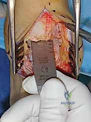 صورة طبية: مفصل الكاحل الصناعي الكلي HINTEGRA: استعادة الحركة والتخلص من الألم مع الأستاذ الدكتور محمد هطيف في صنعاء