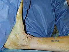 تخطيط القطع العظمي