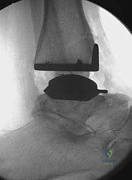 صورة توضيحية لـ مفصل الكاحل الصناعي الكلي HINTEGRA: استعادة الحركة والتخلص من الألم مع الأستاذ الدكتور محمد هطيف في صنعاء