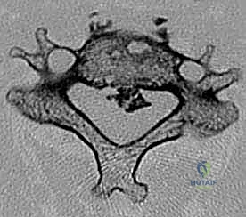 صورة توضيحية لـ استئصال جسم الفقرة العنقية الأمامي ودمج الفقرات الحل الجراحي لتضيق النخاع الشوكي