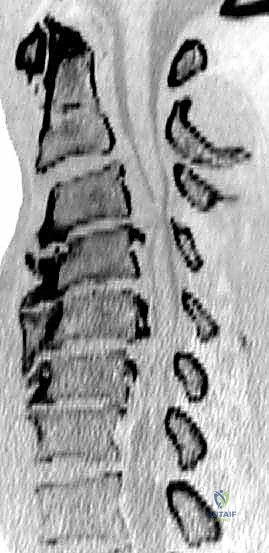 الأستاذ الدكتور محمد هطيف أثناء إجراء جراحة دقيقة للعمود الفقري
