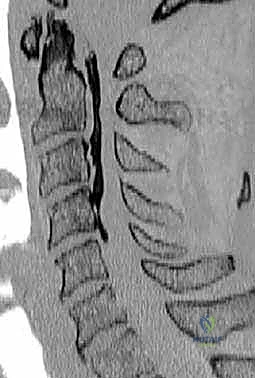 تثبيت الفقرات العنقية بعد كسر معقد