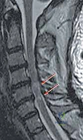 انضغاط الحبل الشوكي العنقي بسبب التكلسات