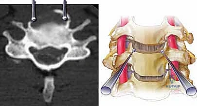 الأعراض العصبية الناتجة عن تضيق النخاع الشوكي