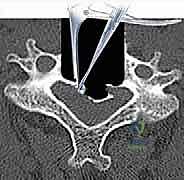 تجهيز المريض وتحديد مكان الشق الجراحي