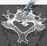 تشريح العمود الفقري العنقي وتوضيح القناة الشوكية