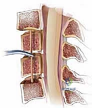 استئصال جسم الفقرة العنقية الأمامي ودمج الفقرات الحل الجراحي لتضيق النخاع الشوكي
