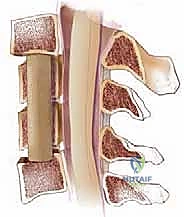 تأثير اعتلال النخاع الشوكي على المهارات الحركية