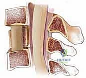 زراعة الدعامة العظمية في الفراغ الفقري