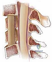الفرق بين استئصال الفقرة واستئصال الغضروف