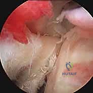 الفحص السريري لتشخيص إصابات الكتف