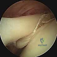 تصوير الرنين المغناطيسي لتقييم وتر العضلة ذات الرأسين