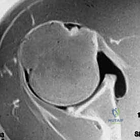أسباب تمزق والتهاب وتر العضلة ذات الرأسين