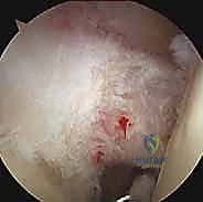 التهاب وتر العضلة ذات الرأسين بالكتف: الأسباب، الأعراض، وخيارات العلاج بالمنظار مع الأستاذ الدكتور محمد هطيف