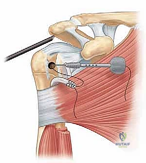 مركب بكرة العضلة ذات الرأسين والتشريح الدقيق للكتف