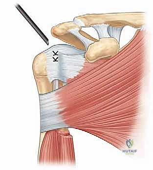 الأعراض السريرية لالتهاب وتر العضلة ذات الرأسين