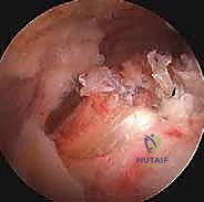 صورة طبية: التهاب وتر العضلة ذات الرأسين بالكتف: الأسباب، الأعراض، وخيارات العلاج بالمنظار مع الأستاذ الدكتور محمد هطيف