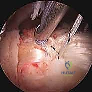 صورة توضيحية لـ التهاب وتر العضلة ذات الرأسين بالكتف: الأسباب، الأعراض، وخيارات العلاج بالمنظار مع الأستاذ الدكتور محمد هطيف