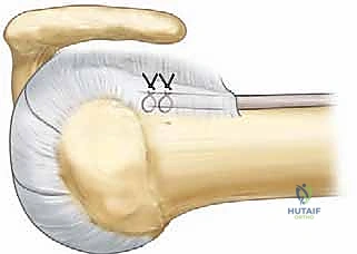 صورة توضيحية لـ التهاب وتر العضلة ذات الرأسين بالكتف: الأسباب، الأعراض، وخيارات العلاج بالمنظار مع الأستاذ الدكتور محمد هطيف