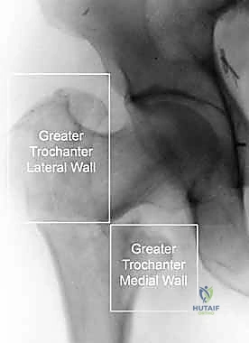 تخطيط الجراحة لكسور الفخذ