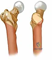 صورة شعاعية توضح تشريح الكسر