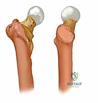 تحديد زاوية عنق الفخذ