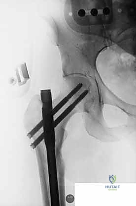 توجيه المسمار داخل العظم