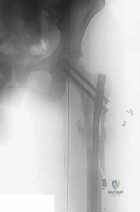 التسمير النخاعي الرأسي الفخذي لكسور الفخذ القريب: دليل شامل للمرضى