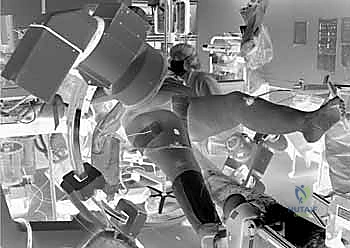 صورة شعاعية توضح مسار المسمار العنقي