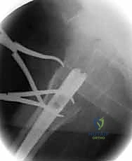 تجهيز مسامير الغلق السفلية