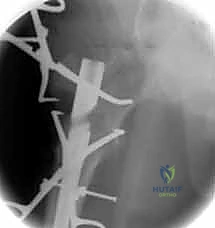 استخدام مفك خاص لتثبيت المسمار