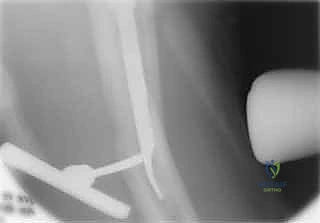 تحديد موقع المسامير السفلية بالأشعة