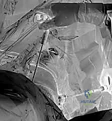 صورة توضيحية لـ التسمير النخاعي الرأسي الفخذي لكسور الفخذ القريب: دليل شامل للمرضى