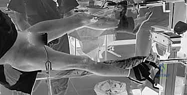 صورة شعاعية للوضع النهائي للرأس