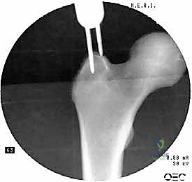 صورة توضيحية لـ التسمير النخاعي الرأسي الفخذي