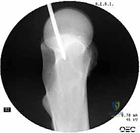 إدخال السلك الدليلي