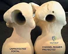 صورة طبية: التسمير النخاعي الرأسي الفخذي لكسور الفخذ القريب: دليل شامل للمرضى