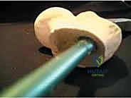 صورة توضيحية لـ التسمير النخاعي الرأسي الفخذي لكسور الفخذ القريب: دليل شامل للمرضى