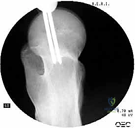 إحداث شق صغير للمسامير السفلية