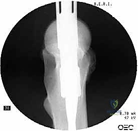 صورة طبية: التسمير النخاعي الرأسي الفخذي لكسور الفخذ القريب: دليل شامل للمرضى
